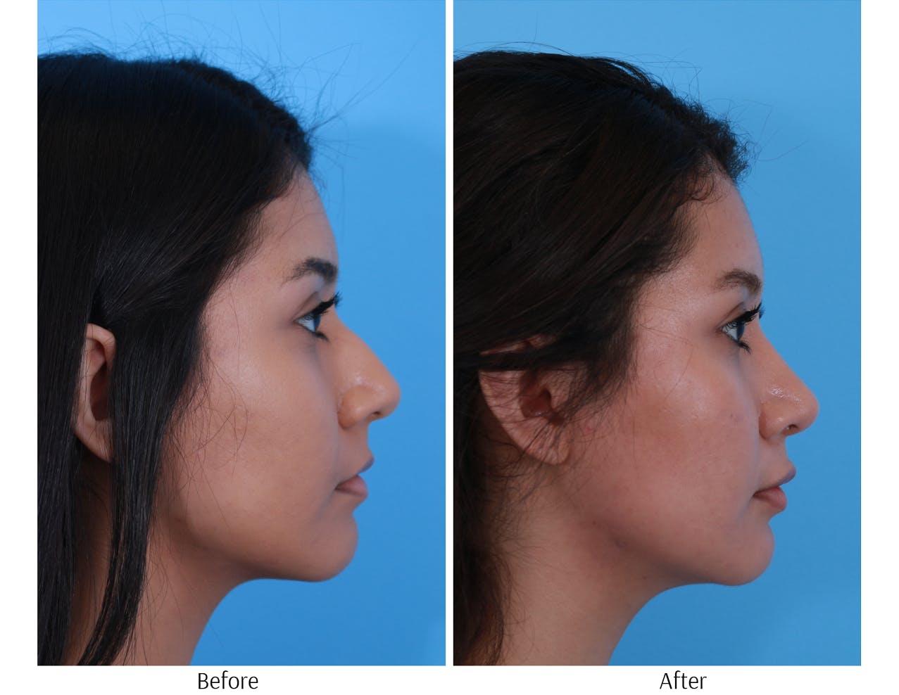 Rhinoplasty Before & After Gallery - Patient 64080950 - Image 1