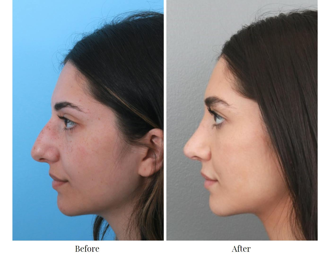 Rhinoplasty Before & After Gallery - Patient 64080951 - Image 2