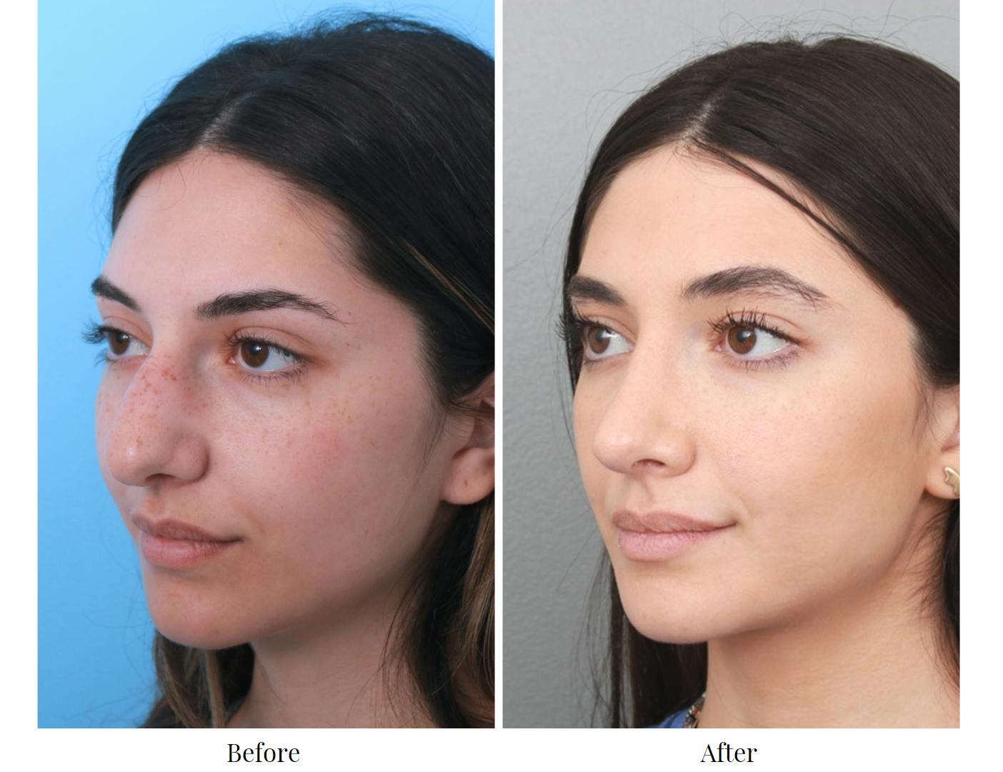 Rhinoplasty Before & After Gallery - Patient 64080951 - Image 3