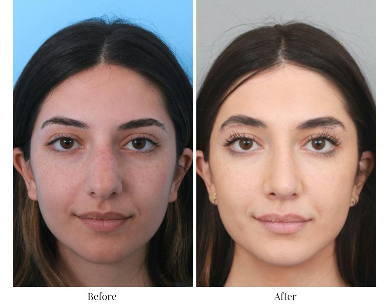 Rhinoplasty Before & After Gallery - Patient 64080951 - Image 4