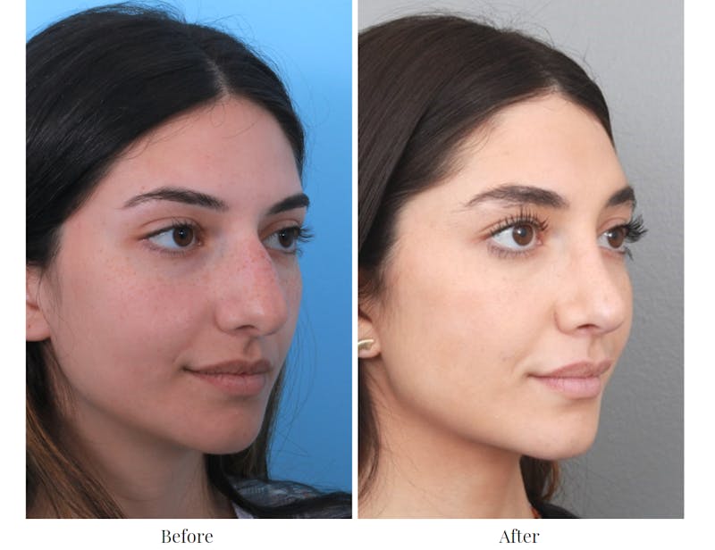 Rhinoplasty Before & After Gallery - Patient 64080951 - Image 1