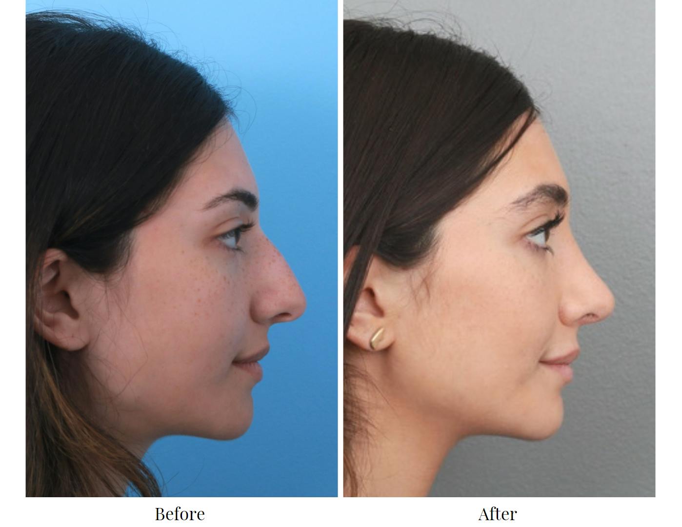 Rhinoplasty Before & After Gallery - Patient 64080951 - Image 5