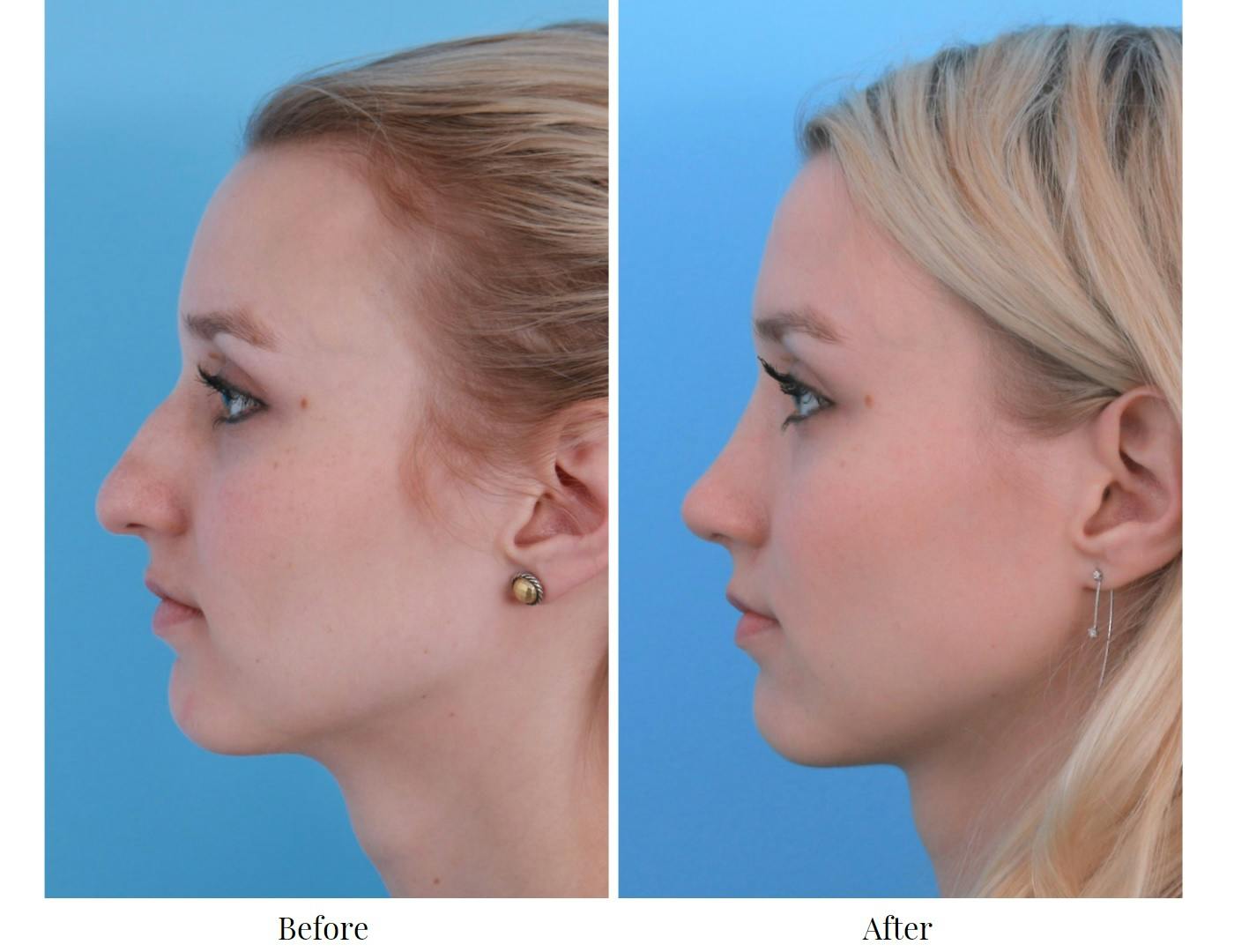 Rhinoplasty Before & After Gallery - Patient 64080952 - Image 2