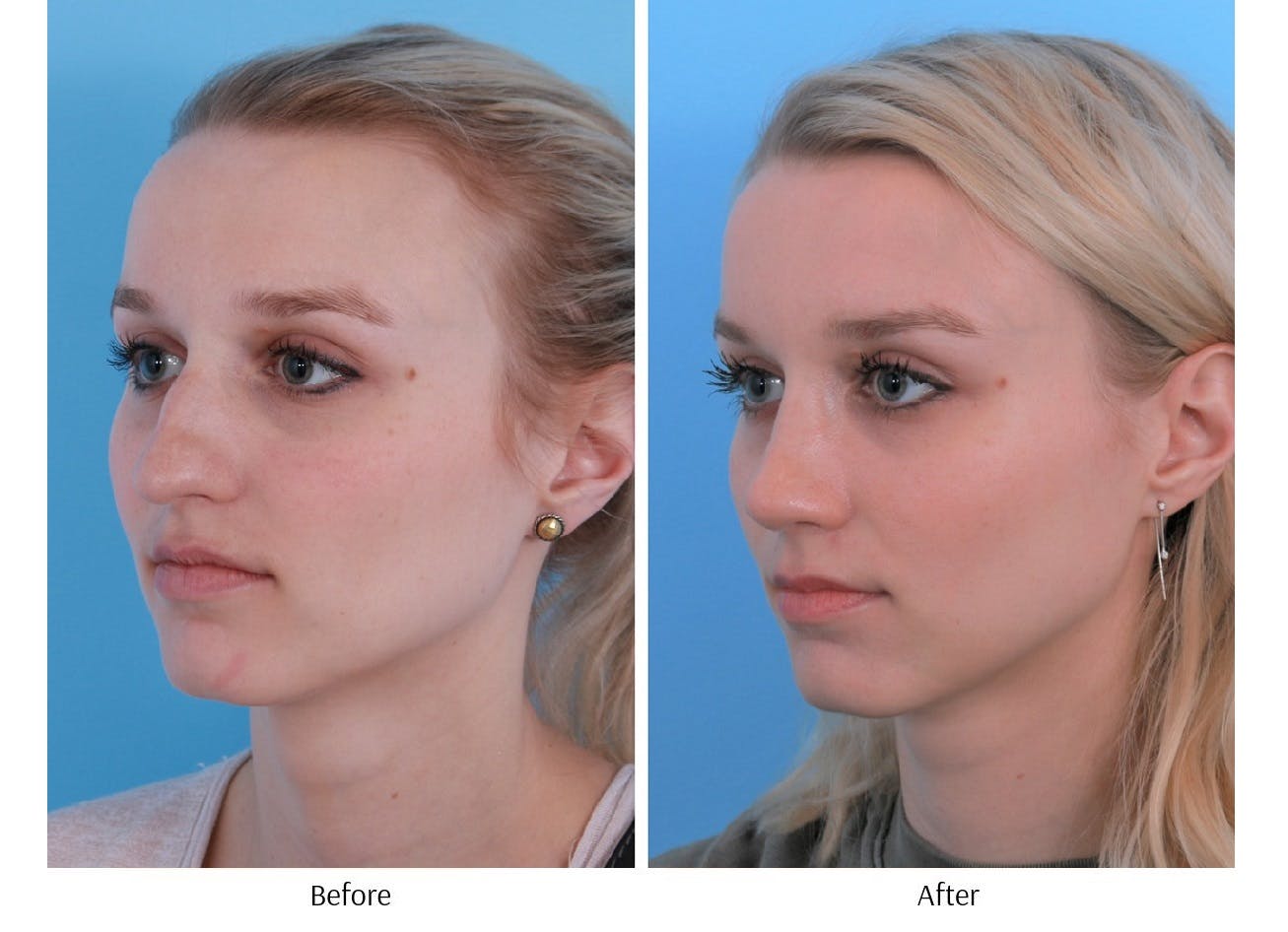 Rhinoplasty Before & After Gallery - Patient 64080952 - Image 3