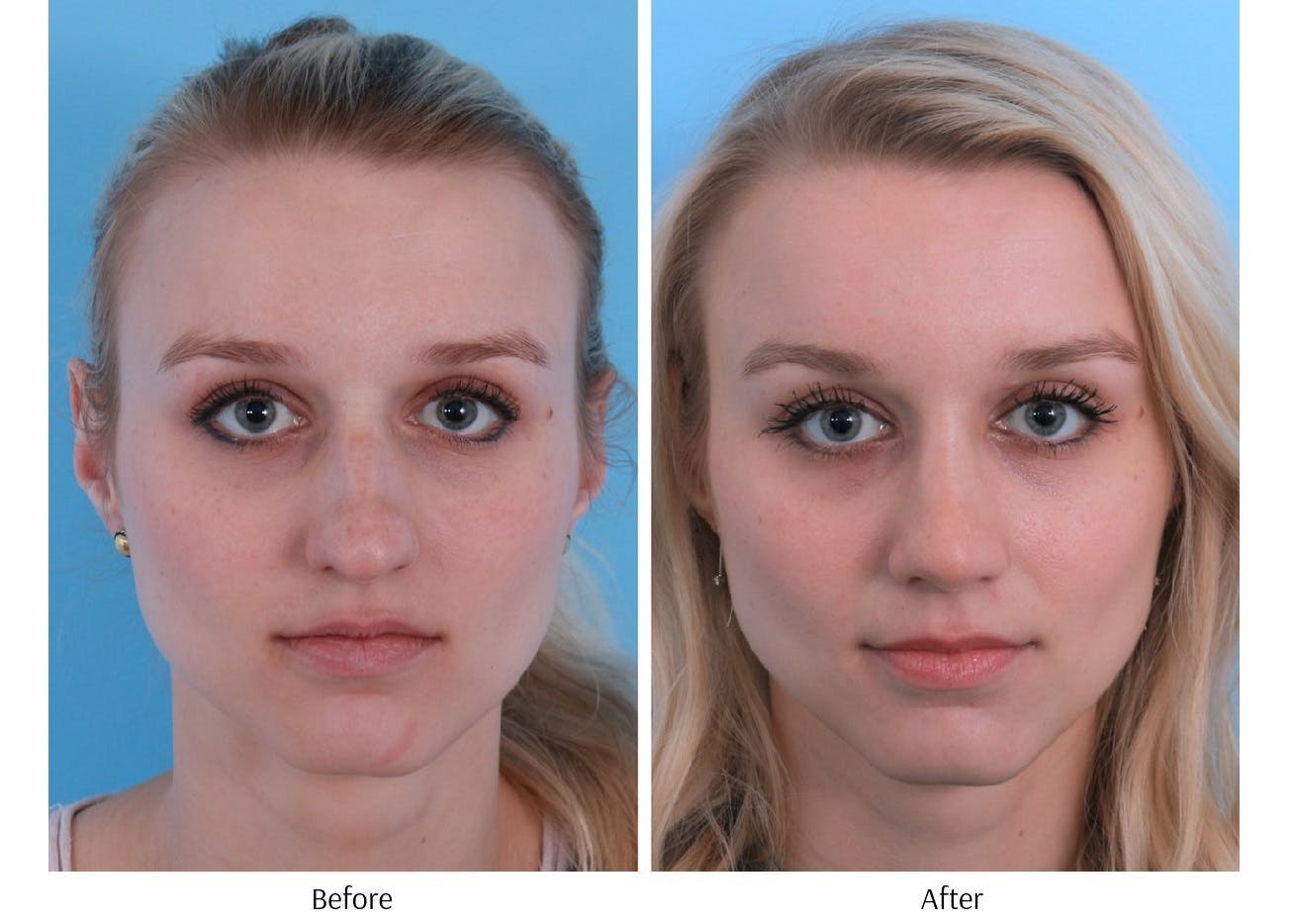 Rhinoplasty Before & After Gallery - Patient 64080952 - Image 1
