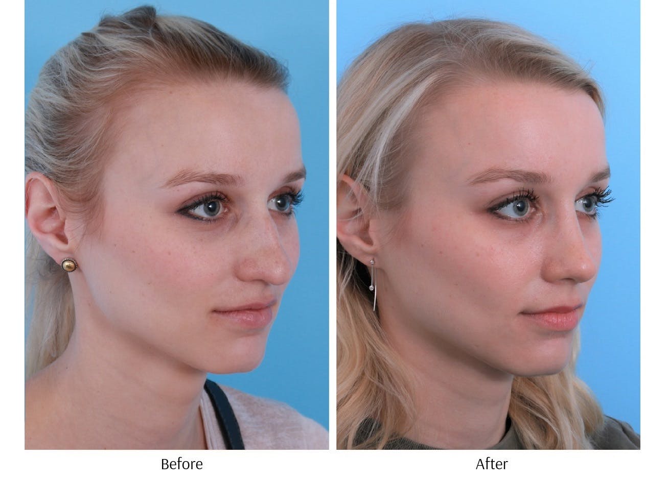 Rhinoplasty Before & After Gallery - Patient 64080952 - Image 4