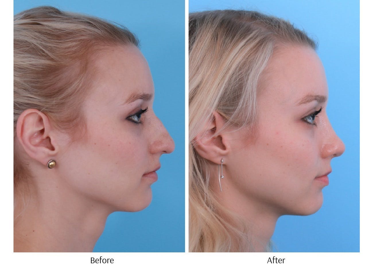 Rhinoplasty Before & After Gallery - Patient 64080952 - Image 5