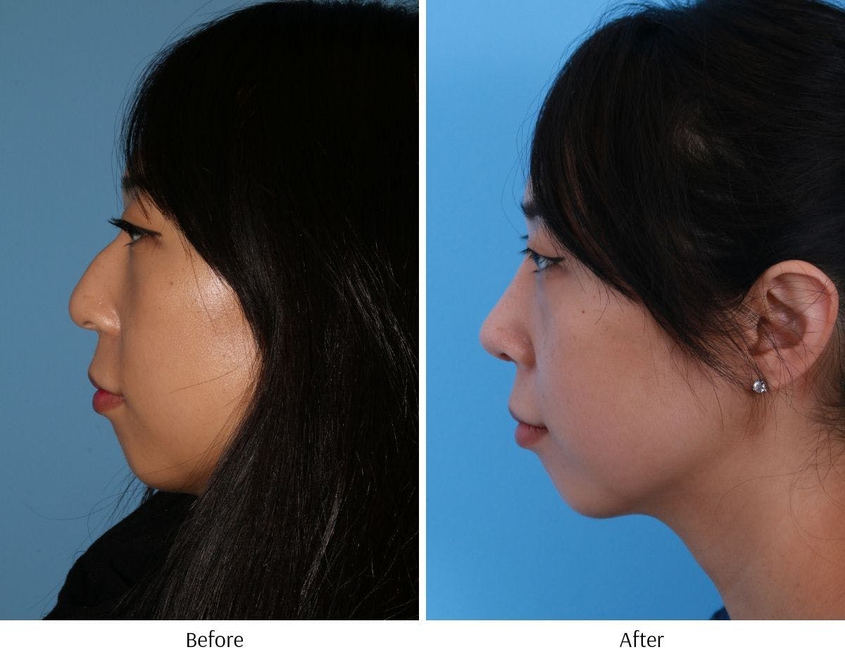 Rhinoplasty Before & After Gallery - Patient 64080953 - Image 2