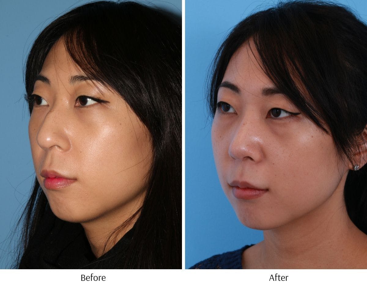 Rhinoplasty Before & After Gallery - Patient 64080953 - Image 3