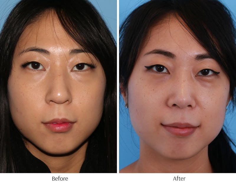 Rhinoplasty Before & After Gallery - Patient 64080953 - Image 1