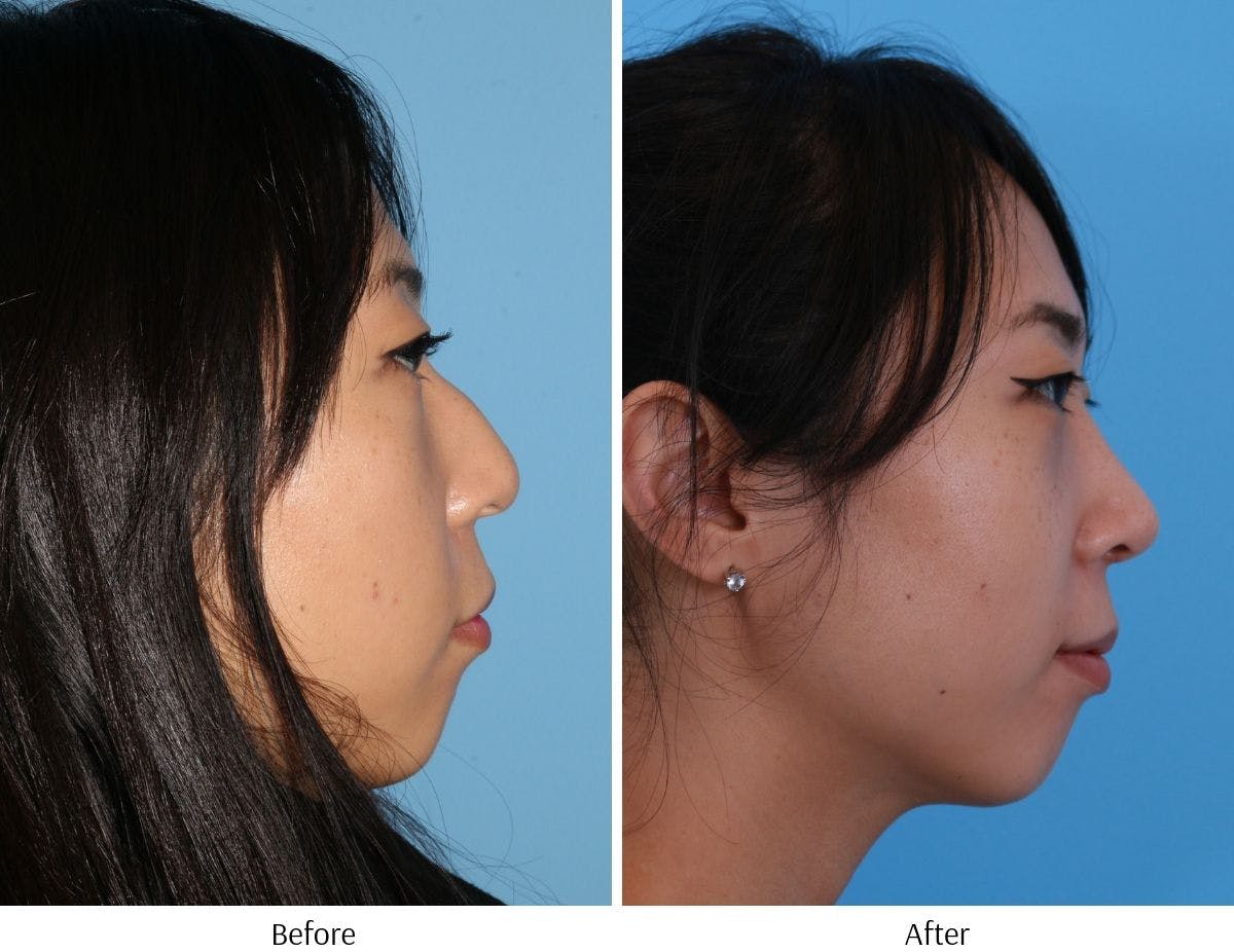 Rhinoplasty Before & After Gallery - Patient 64080953 - Image 5