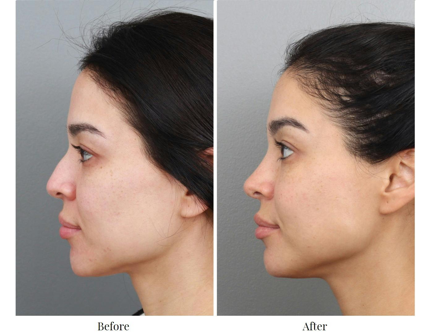 Rhinoplasty Before & After Gallery - Patient 64080954 - Image 2