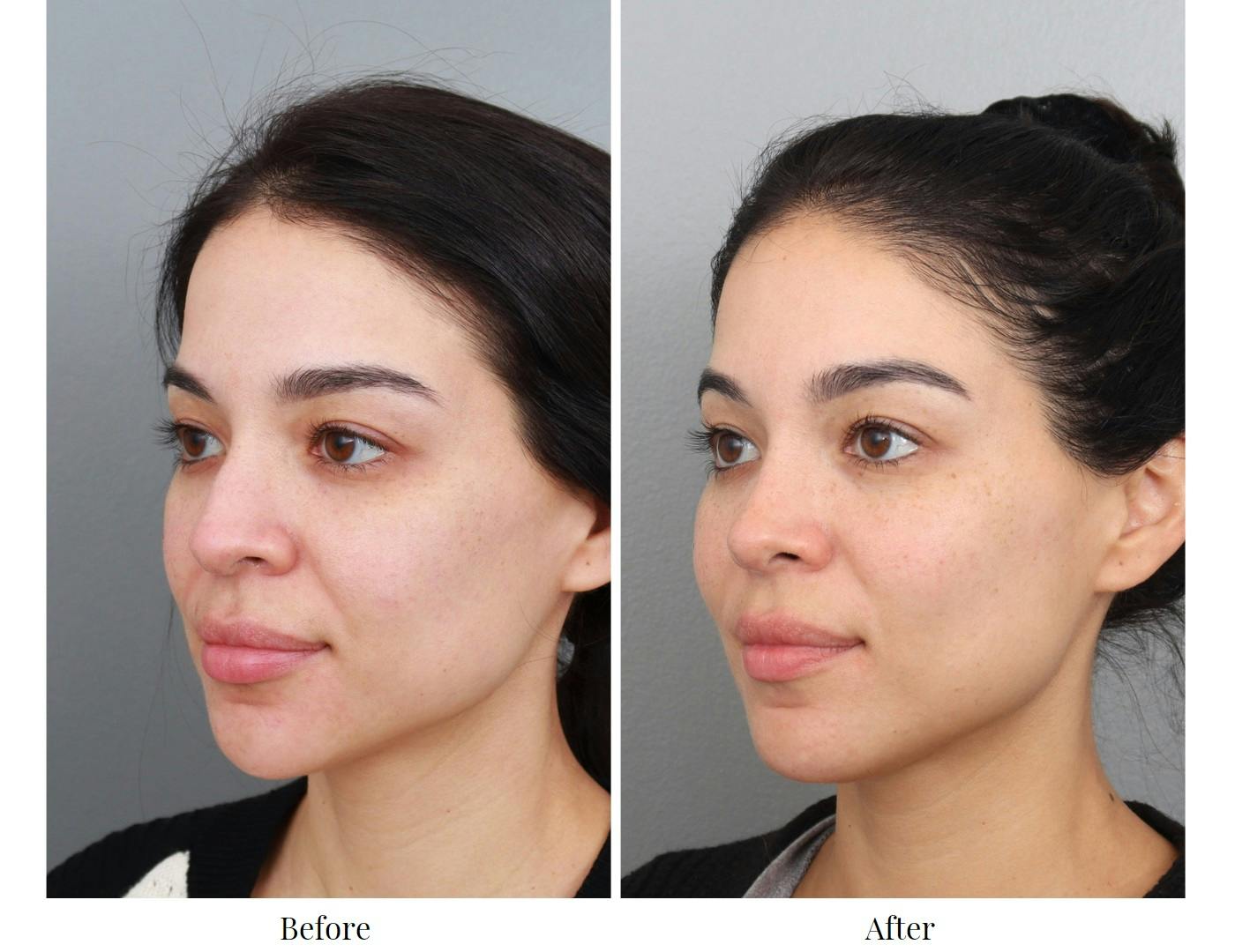 Rhinoplasty Before & After Gallery - Patient 64080954 - Image 3