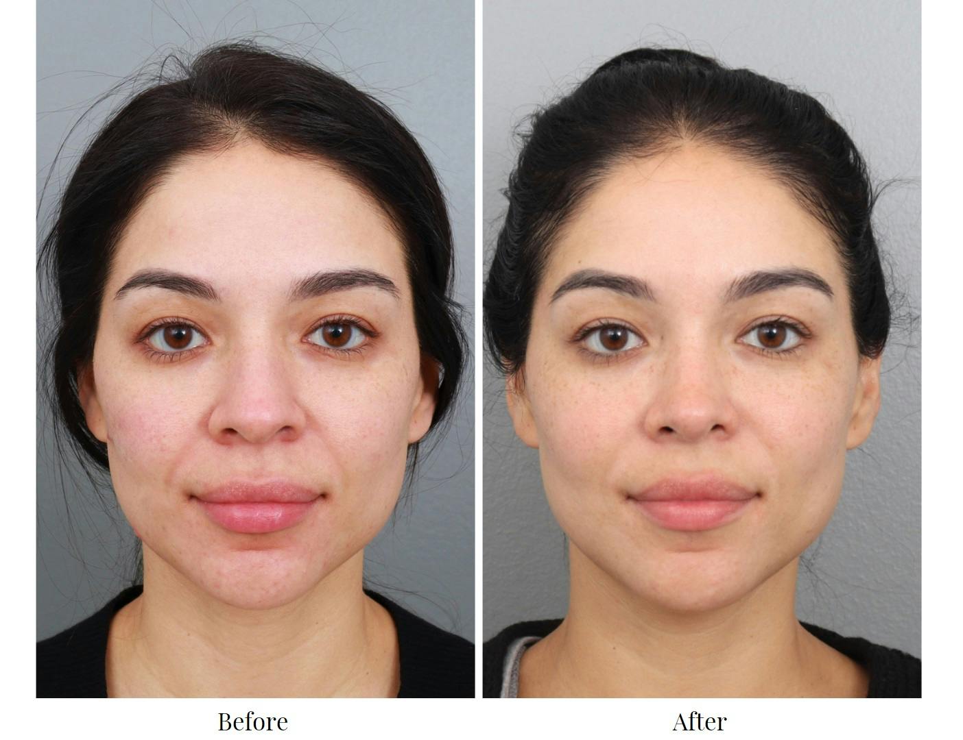 Rhinoplasty Before & After Gallery - Patient 64080954 - Image 4