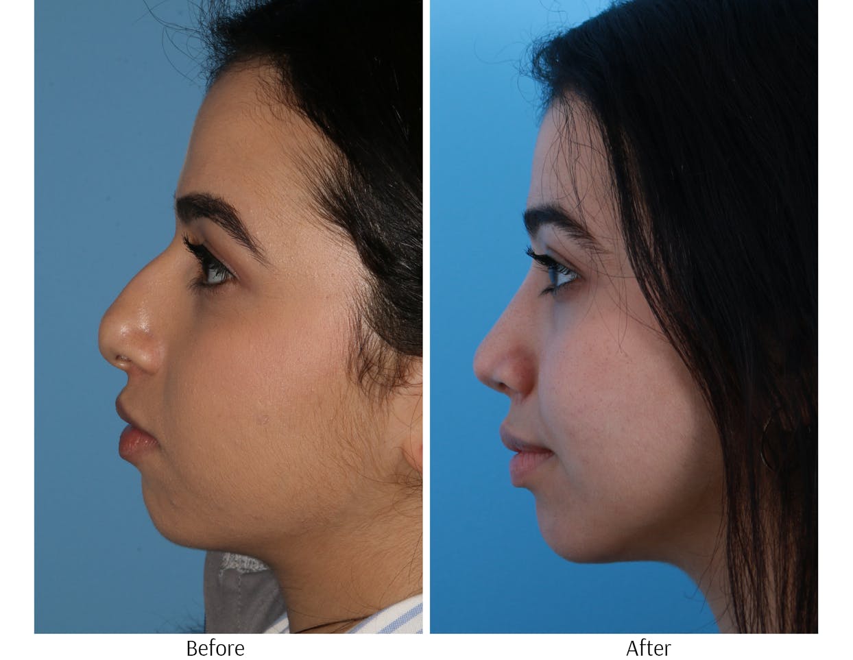 Rhinoplasty Before & After Gallery - Patient 64080957 - Image 2