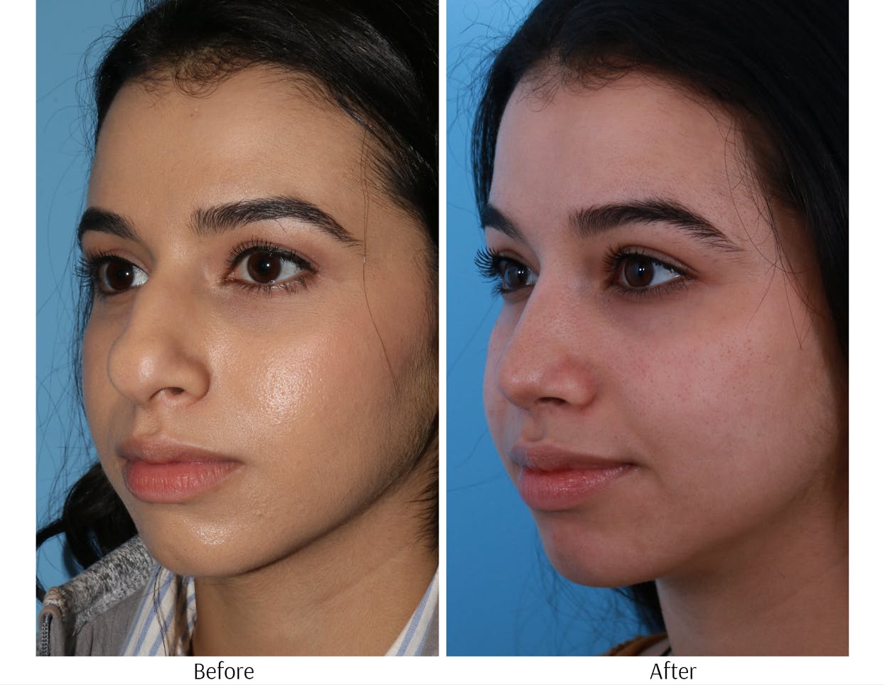 Rhinoplasty Before & After Gallery - Patient 64080957 - Image 3