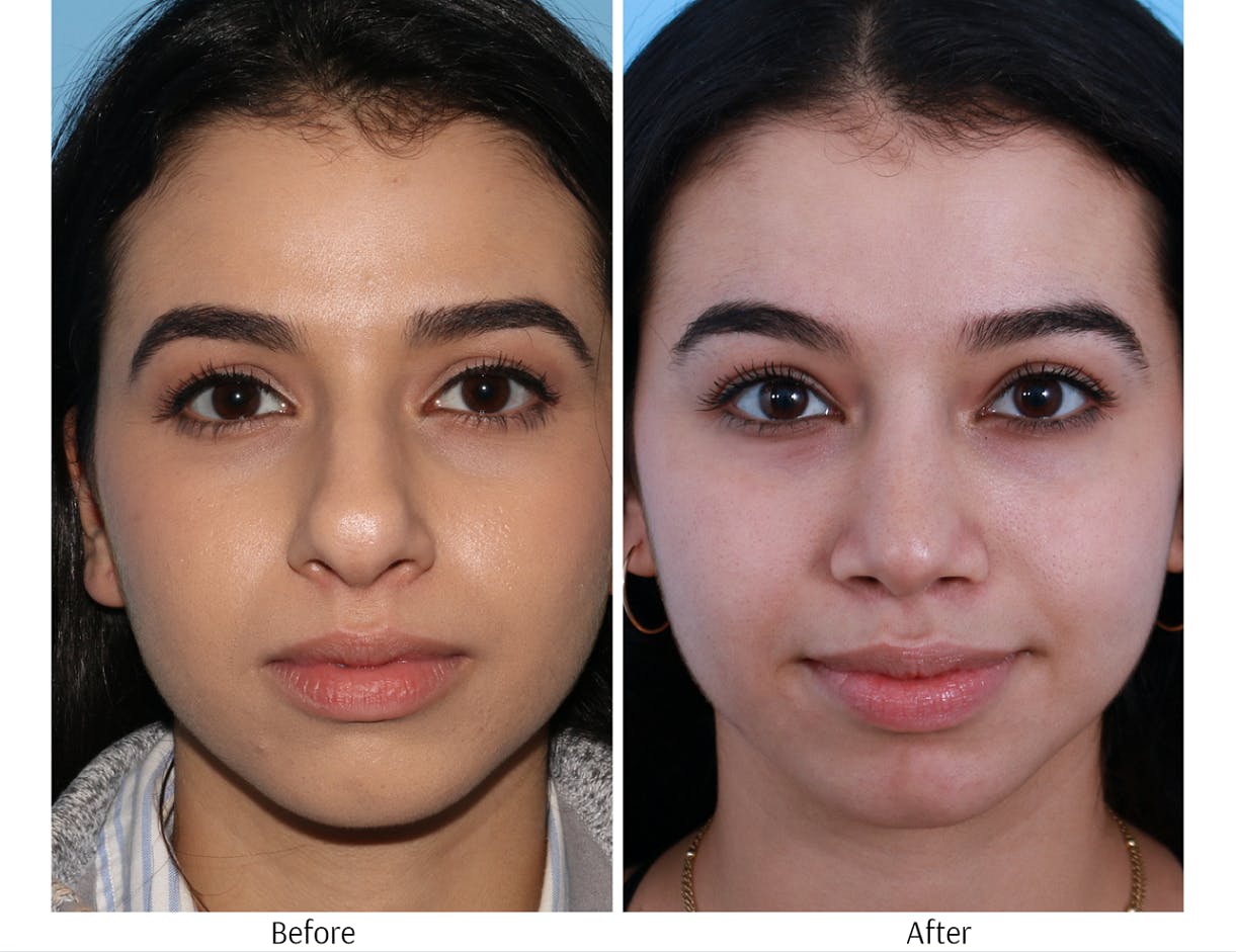 Rhinoplasty Before & After Gallery - Patient 64080957 - Image 4