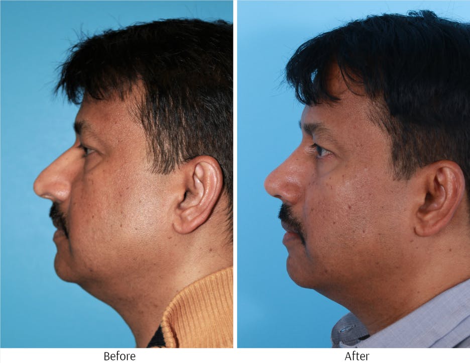 Rhinoplasty Before & After Gallery - Patient 64080958 - Image 2