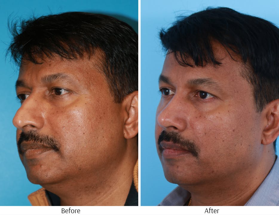 Rhinoplasty Before & After Gallery - Patient 64080958 - Image 3