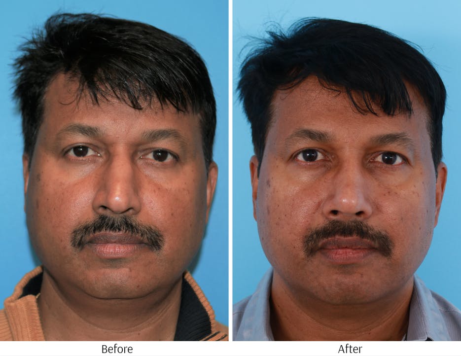 Rhinoplasty Before & After Gallery - Patient 64080958 - Image 4