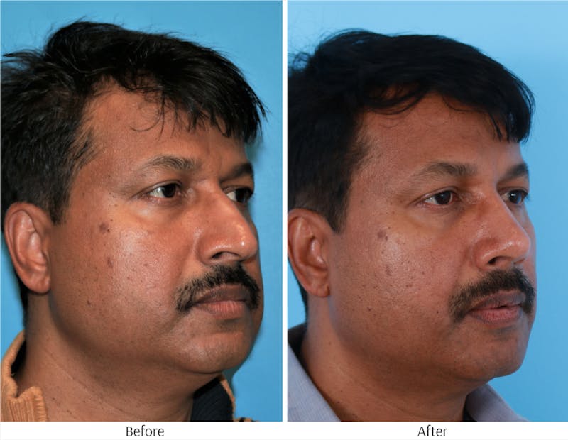 Rhinoplasty Before & After Gallery - Patient 64080958 - Image 1