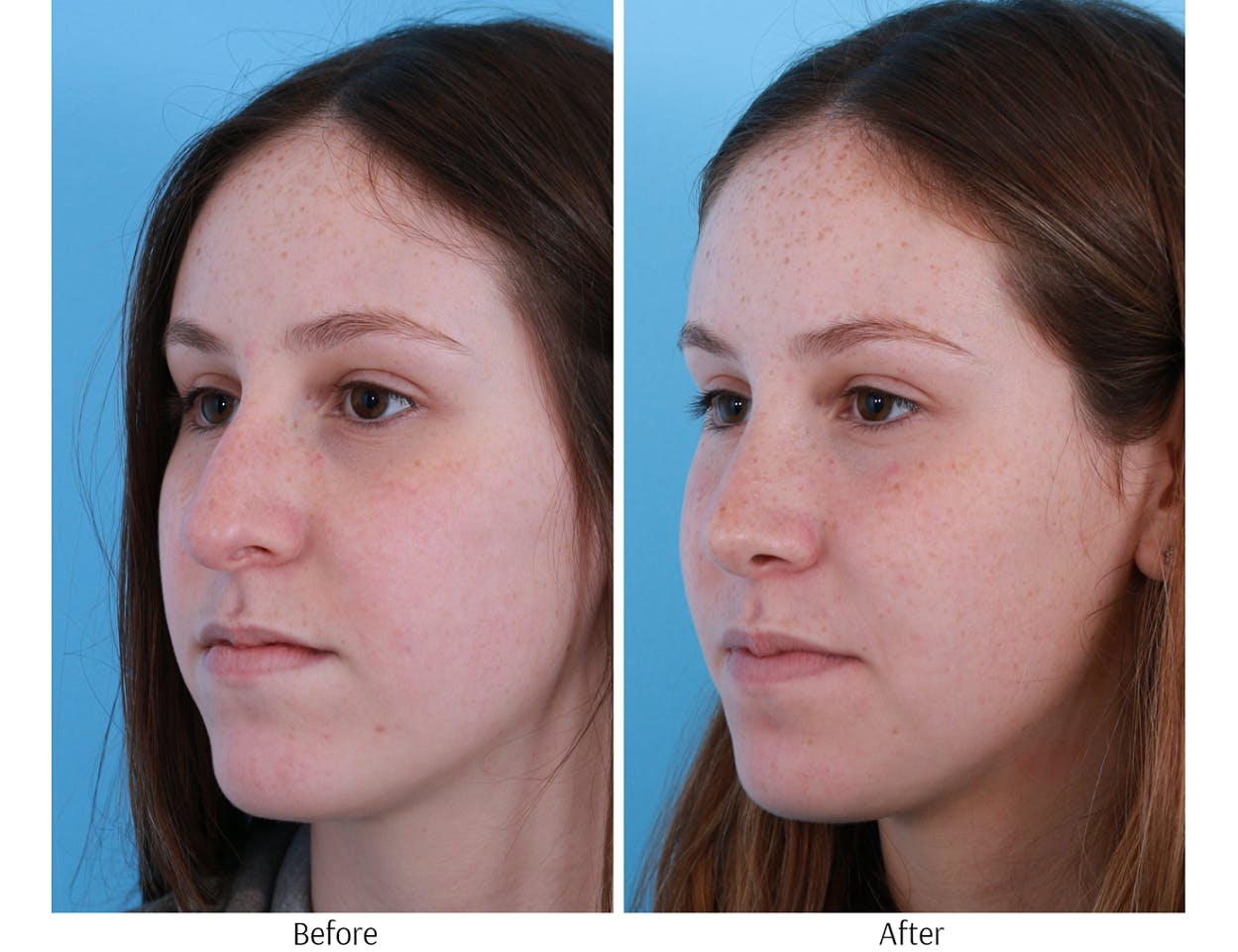 Rhinoplasty Before & After Gallery - Patient 64080961 - Image 3