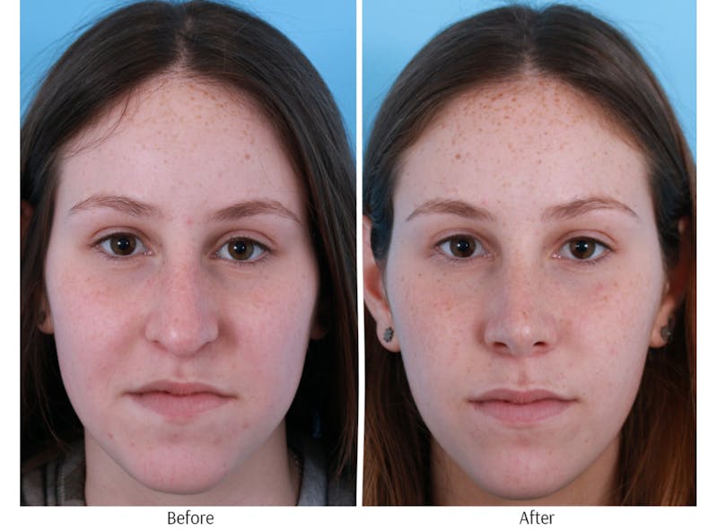 Rhinoplasty Before & After Gallery - Patient 64080961 - Image 1