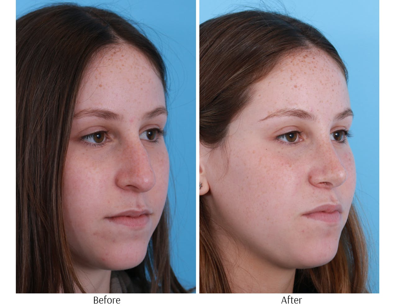 Rhinoplasty Before & After Gallery - Patient 64080961 - Image 4