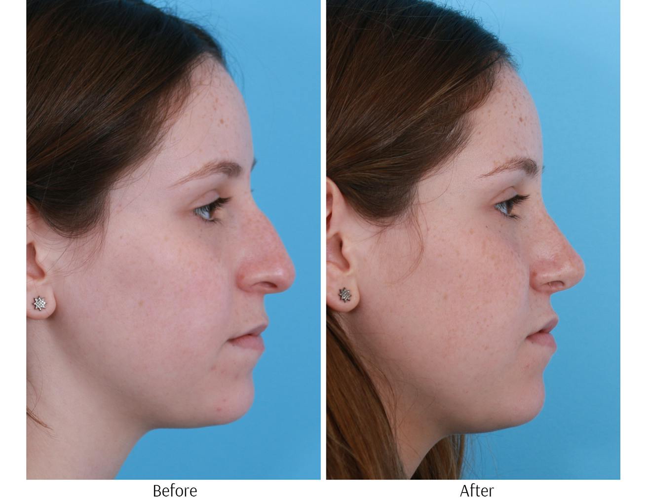 Rhinoplasty Before & After Gallery - Patient 64080961 - Image 5