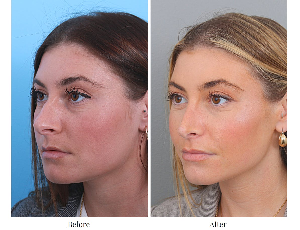Rhinoplasty Before & After Gallery - Patient 64080964 - Image 3