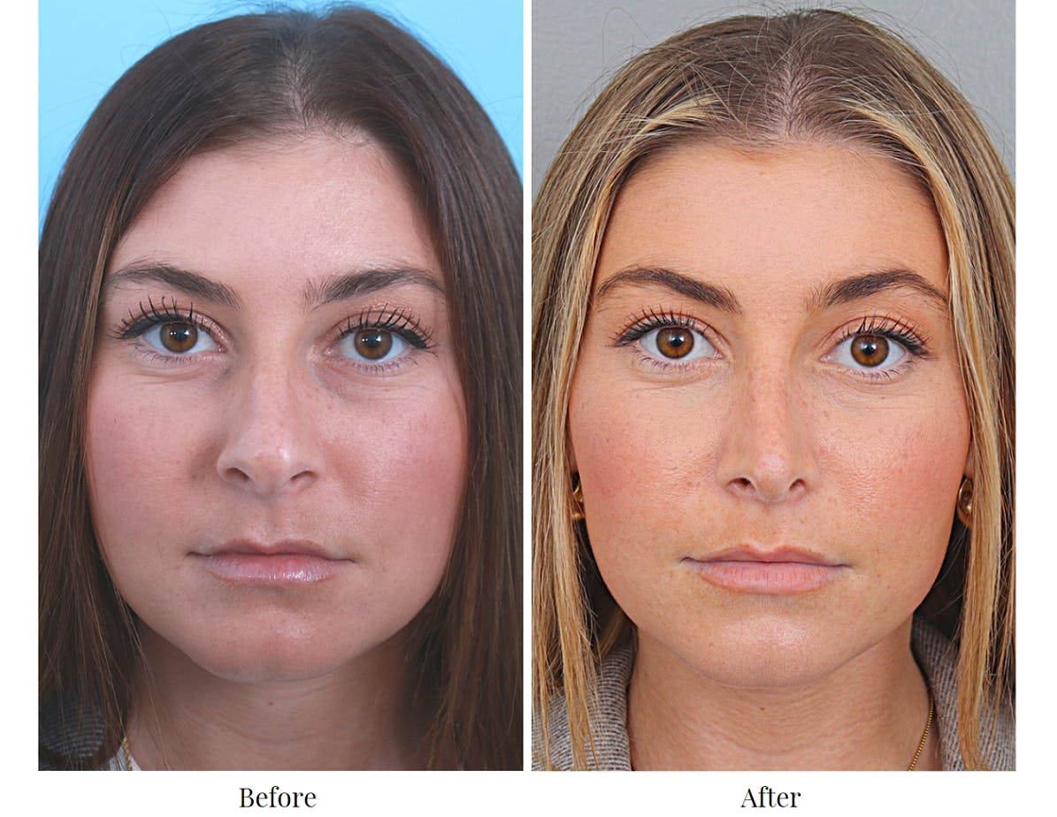 Rhinoplasty Before & After Gallery - Patient 64080964 - Image 4