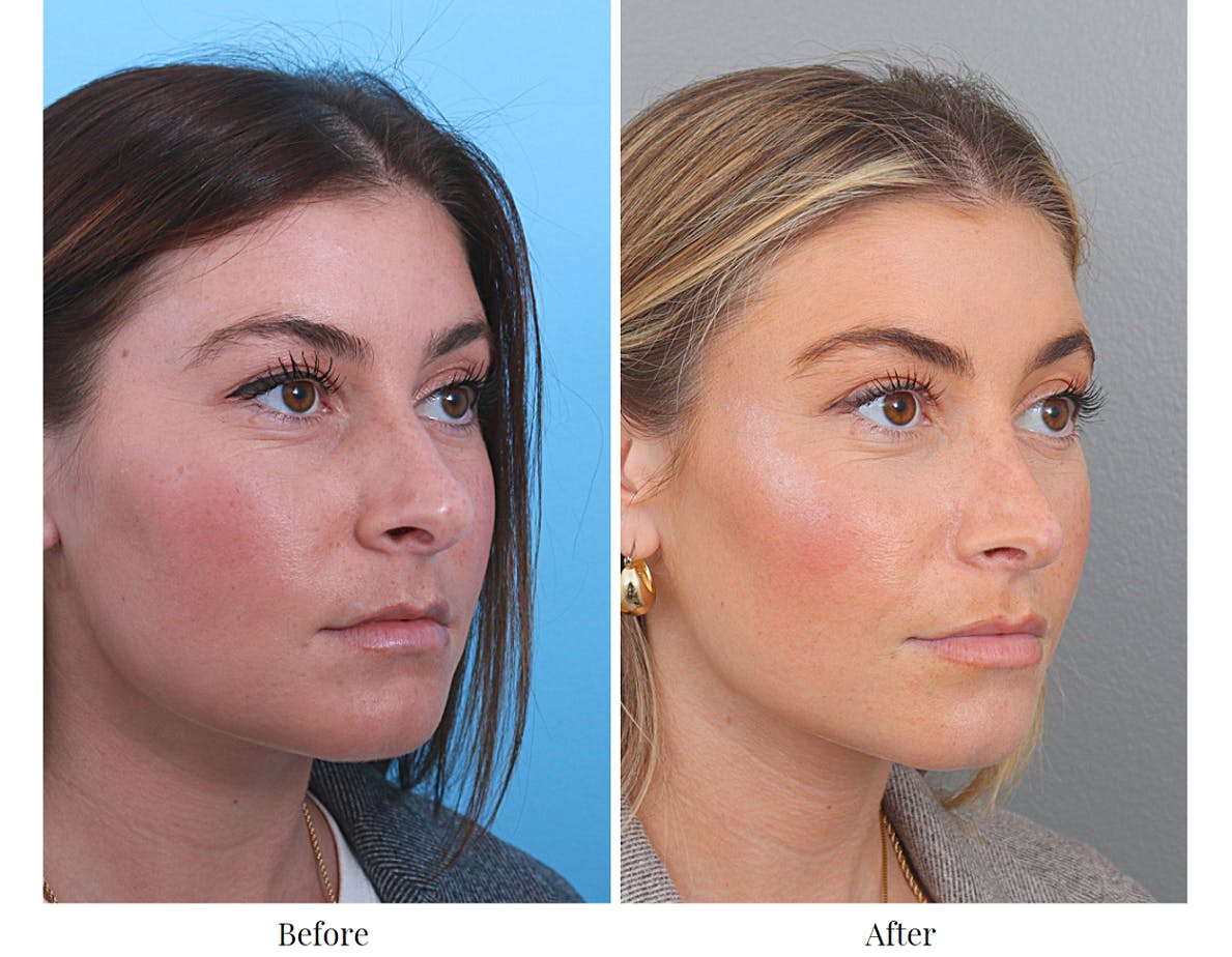 Rhinoplasty Before & After Gallery - Patient 64080964 - Image 1