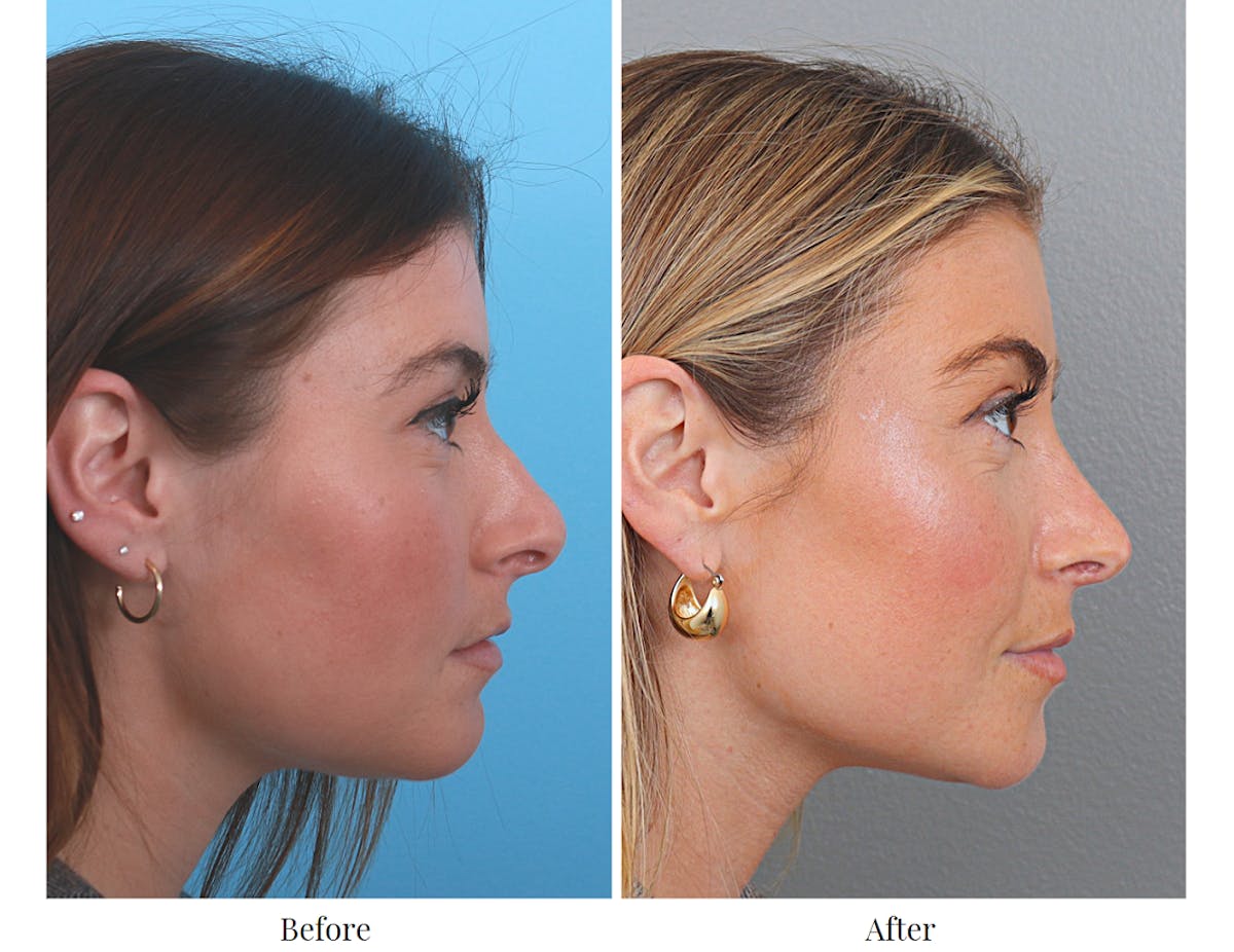 Rhinoplasty Before & After Gallery - Patient 64080964 - Image 5
