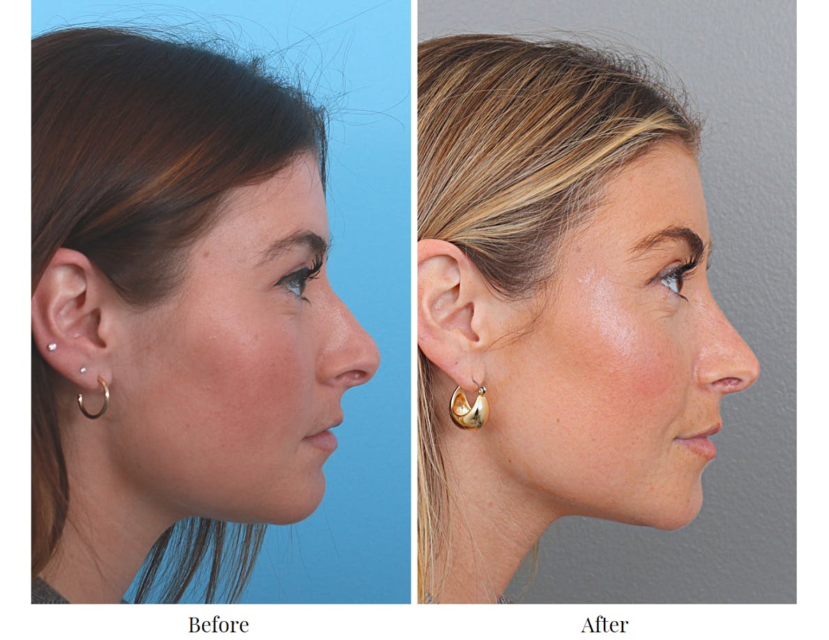 Rhinoplasty Before & After Gallery - Patient 64080964 - Image 5