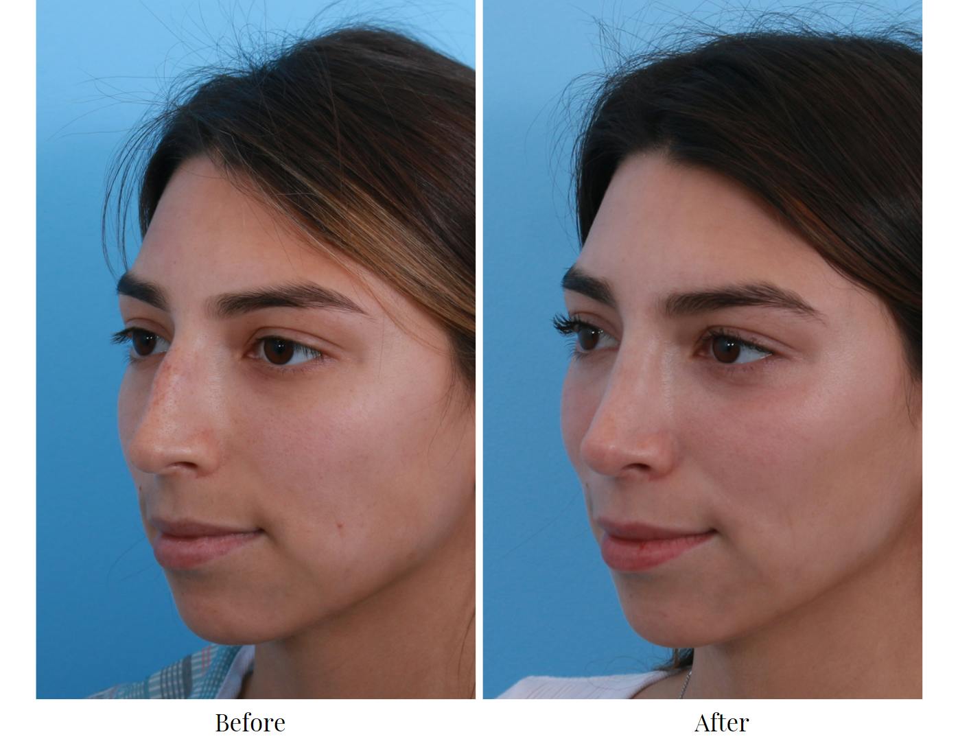 Rhinoplasty Before & After Gallery - Patient 64080965 - Image 3
