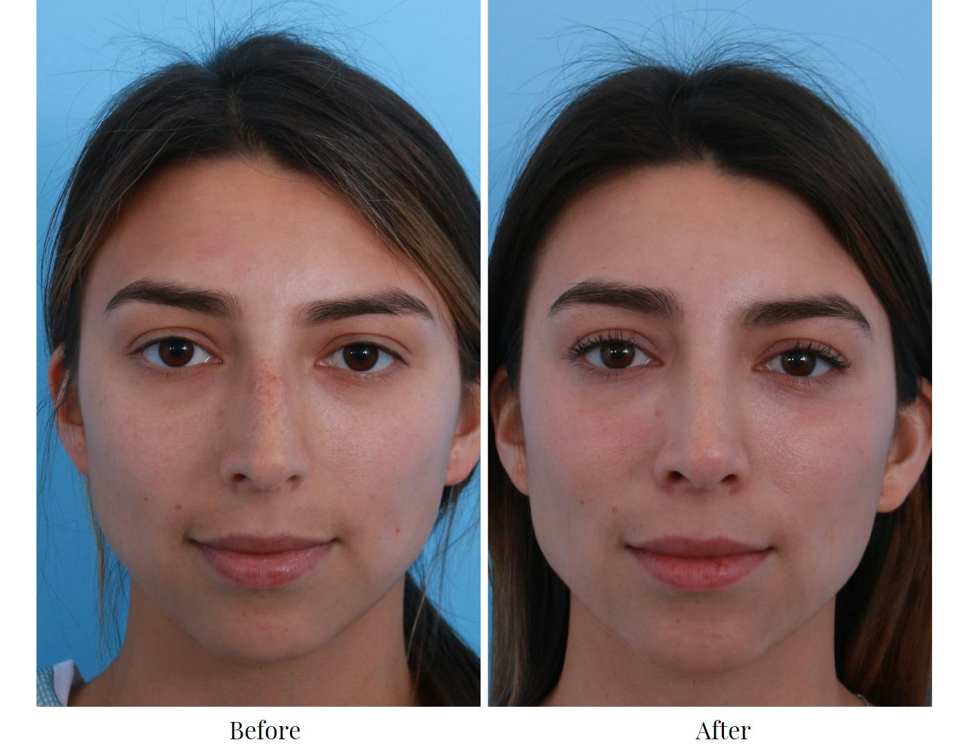 Rhinoplasty Before & After Gallery - Patient 64080965 - Image 4