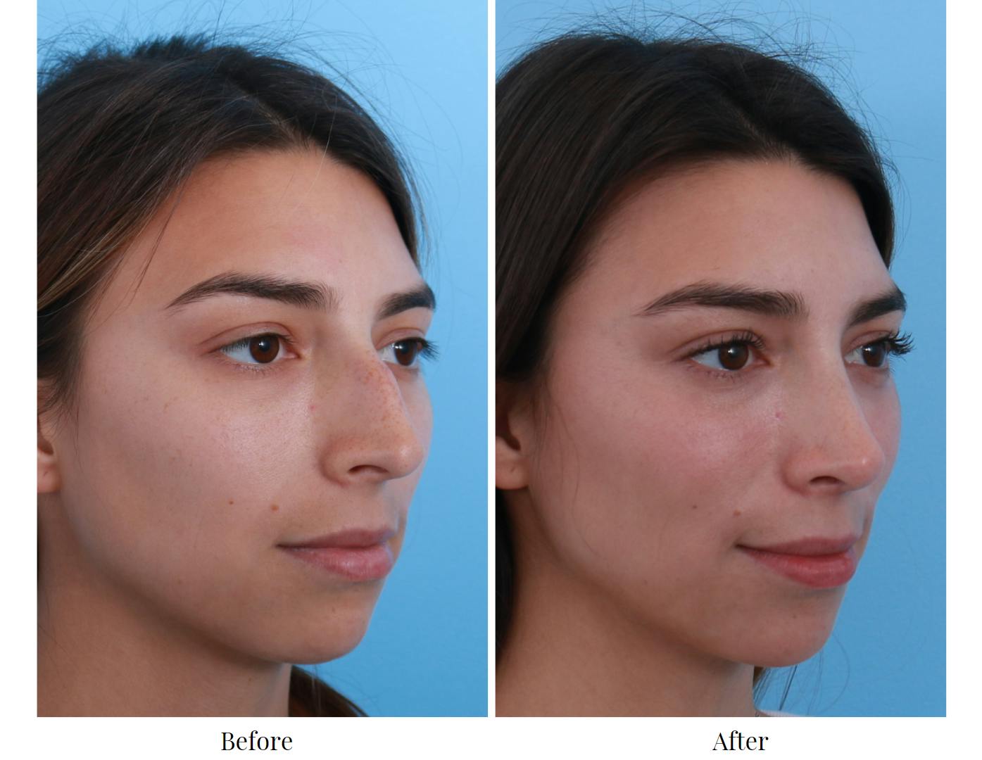 Rhinoplasty Before & After Gallery - Patient 64080965 - Image 5