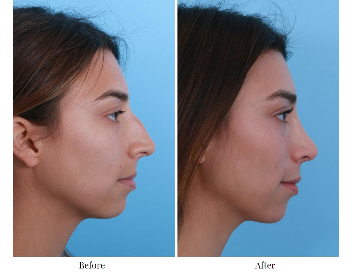 Rhinoplasty Before & After Gallery - Patient 64080965 - Image 1