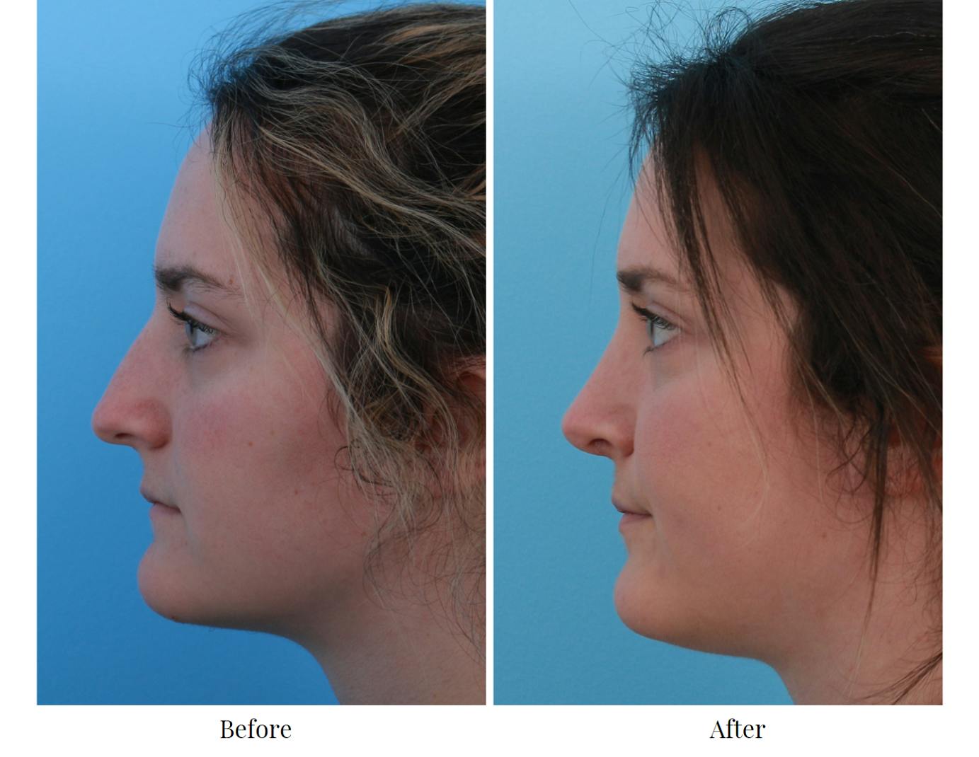 Rhinoplasty Before & After Gallery - Patient 64080966 - Image 2