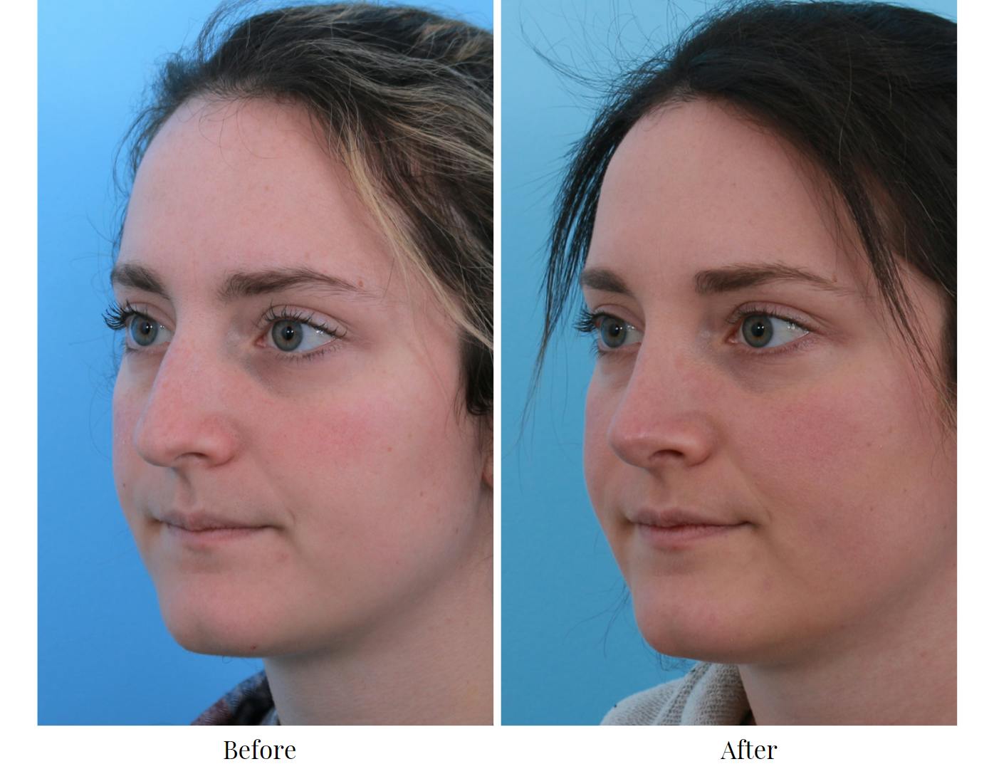 Rhinoplasty Before & After Gallery - Patient 64080966 - Image 3