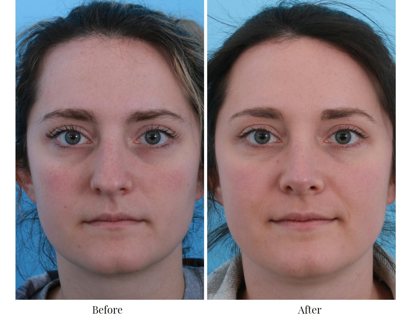 Rhinoplasty Before & After Gallery - Patient 64080966 - Image 1