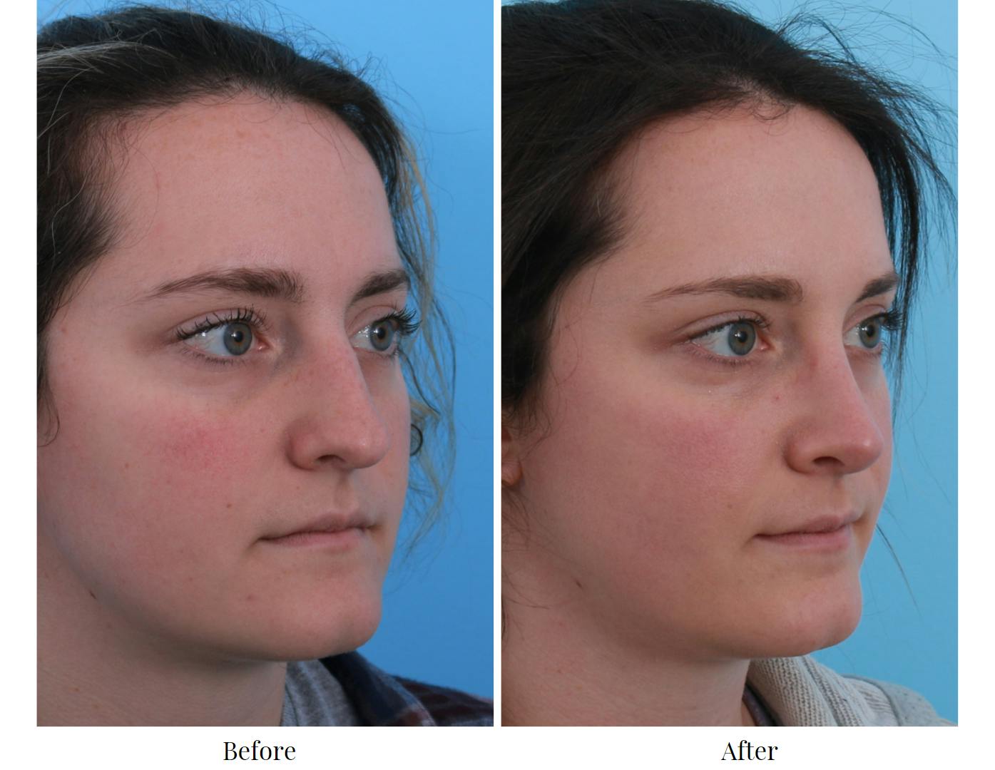 Rhinoplasty Before & After Gallery - Patient 64080966 - Image 4