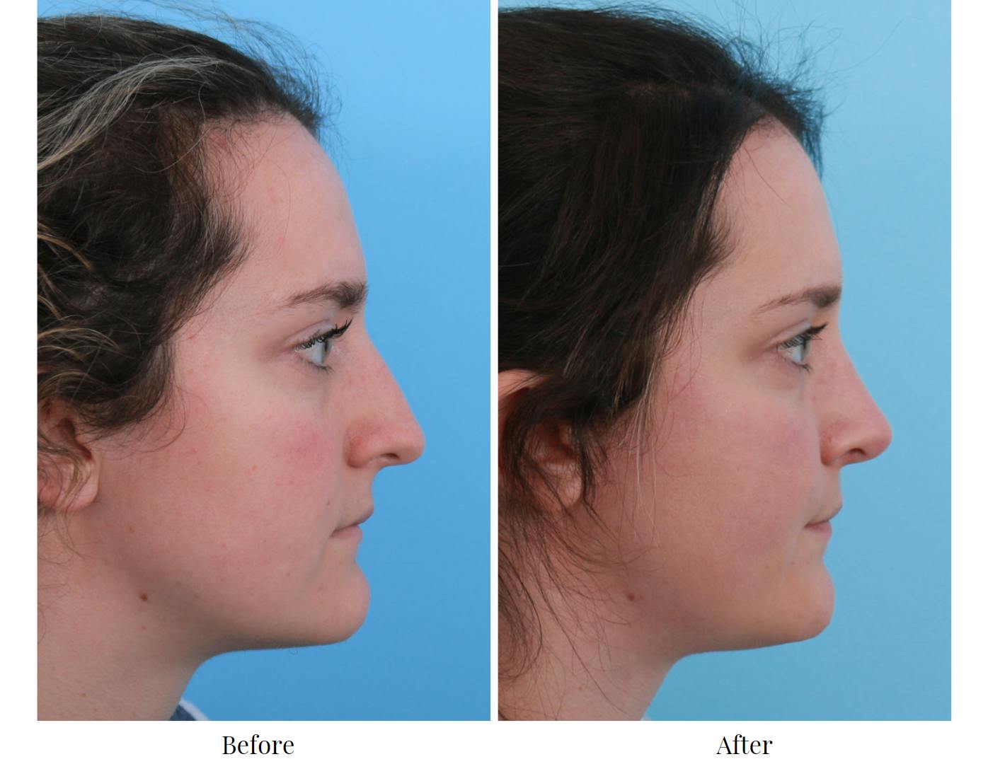 Rhinoplasty Before & After Gallery - Patient 64080966 - Image 5