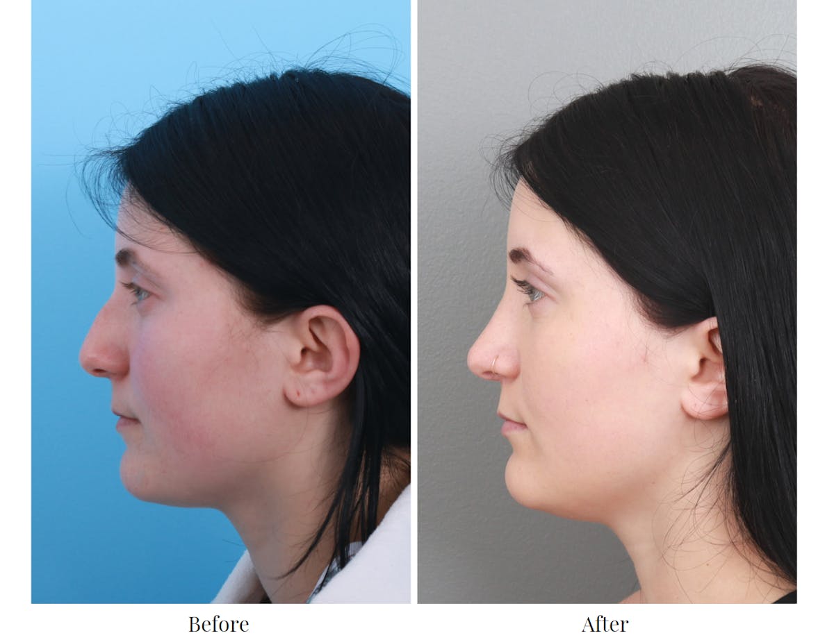 Rhinoplasty Before & After Gallery - Patient 64080970 - Image 2