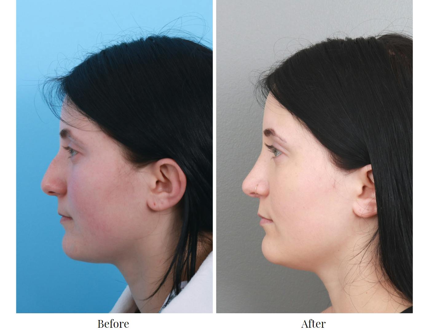 Rhinoplasty Before & After Gallery - Patient 64080970 - Image 2