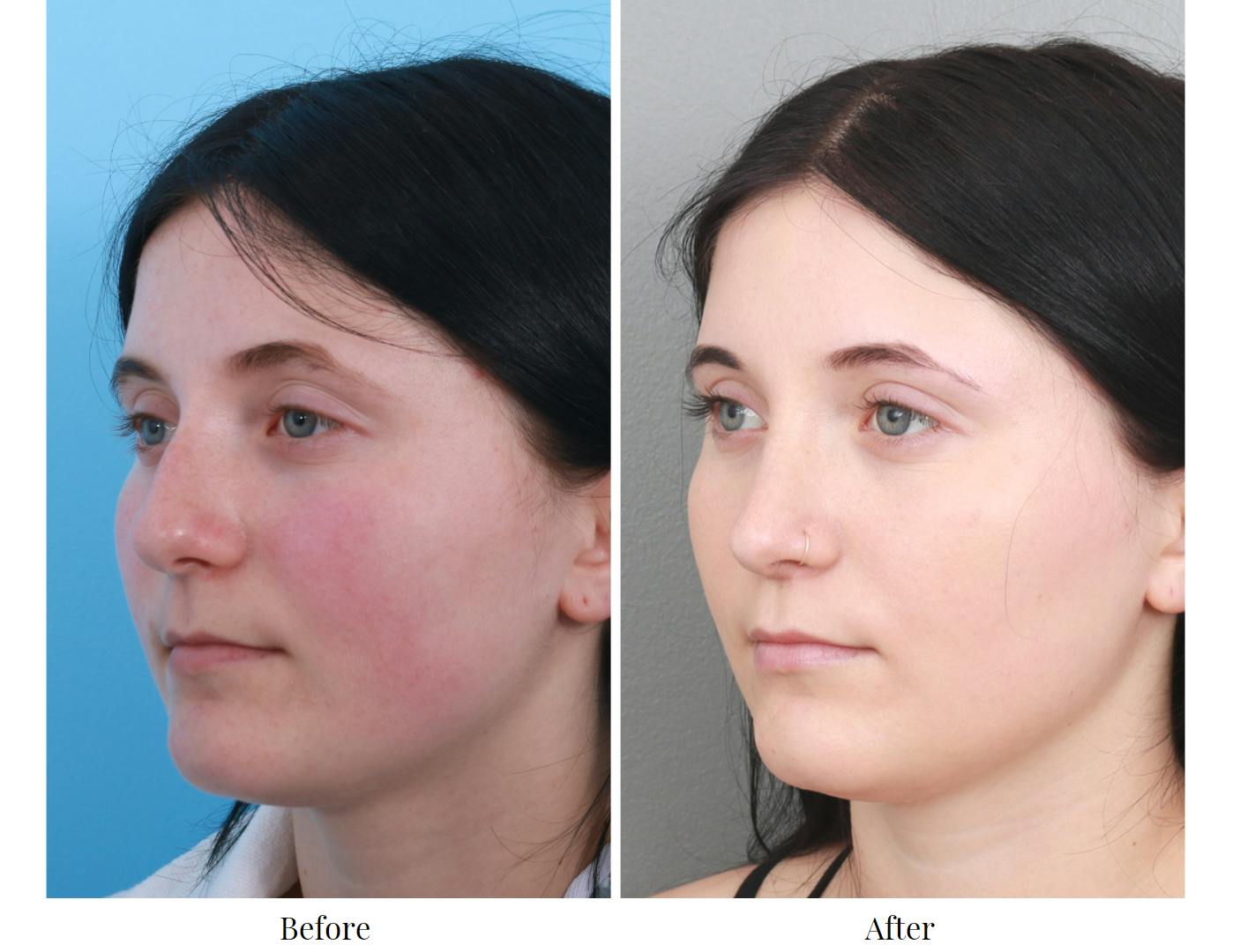 Rhinoplasty Before & After Gallery - Patient 64080970 - Image 1