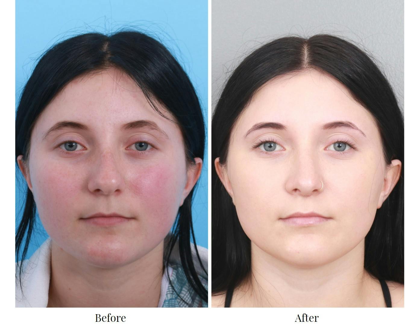 Rhinoplasty Before & After Gallery - Patient 64080970 - Image 3