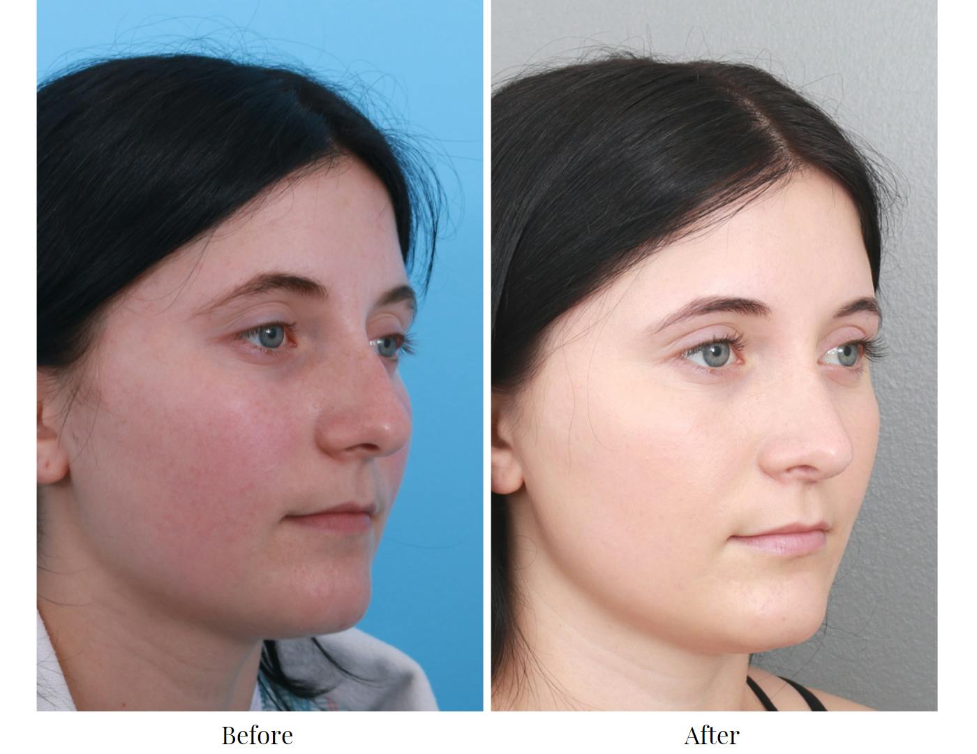 Rhinoplasty Before & After Gallery - Patient 64080970 - Image 5