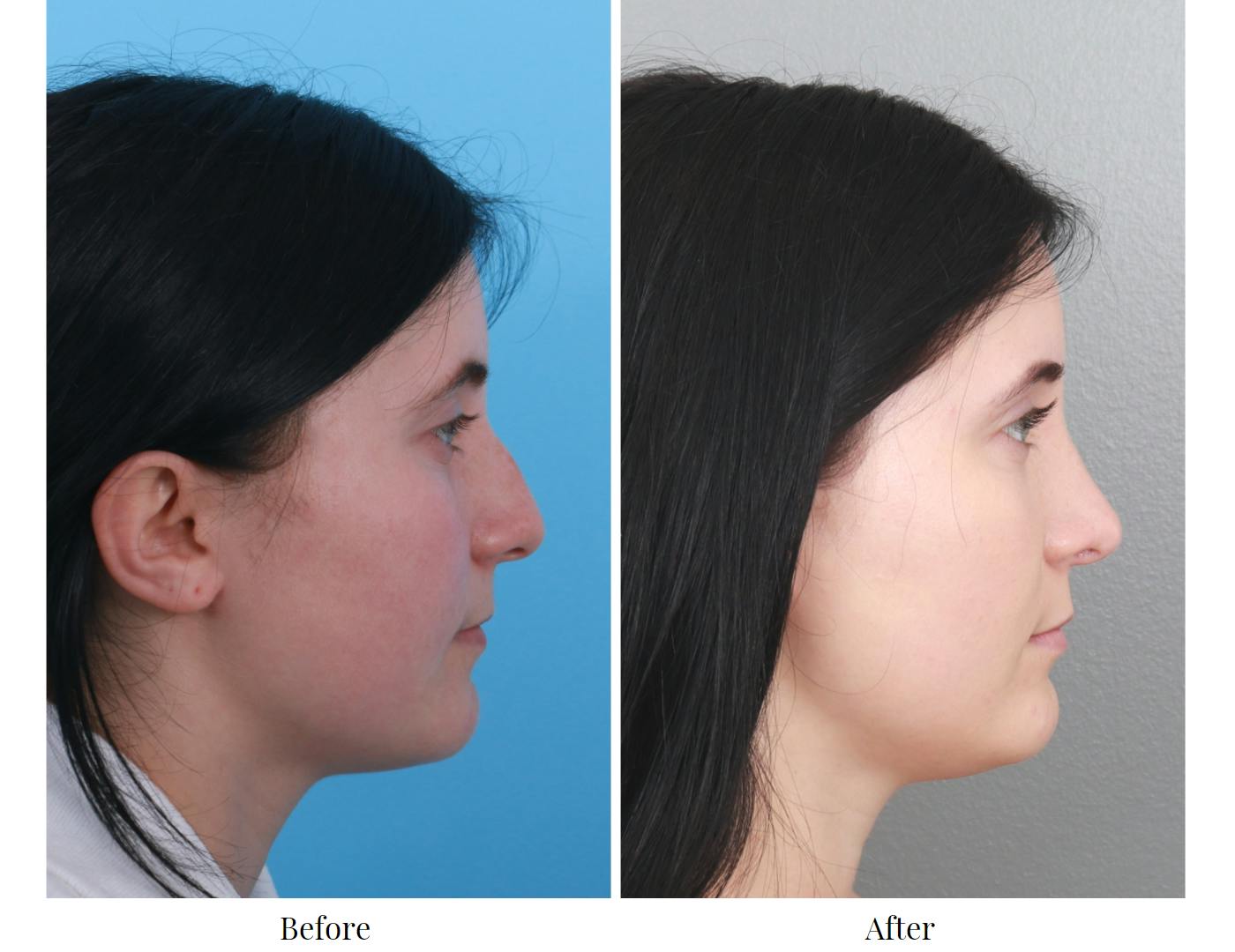 Rhinoplasty Before & After Gallery - Patient 64080970 - Image 4