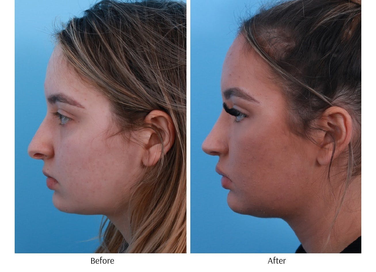 Rhinoplasty Before & After Gallery - Patient 64080971 - Image 2